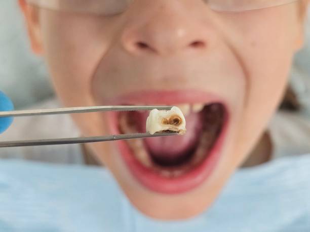 Best Emergency Dental Care for Abscessed Tooth in Sidney, IL
